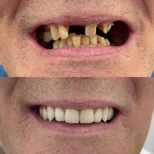 Dental Implants: Why You Should Replace Missing Teeth