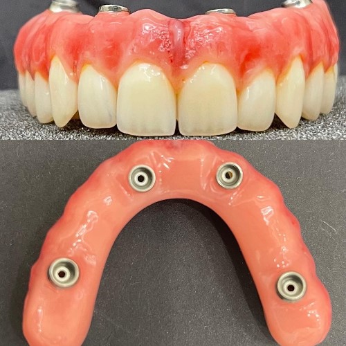 Dental Implants: Why You Should Replace Missing Teeth